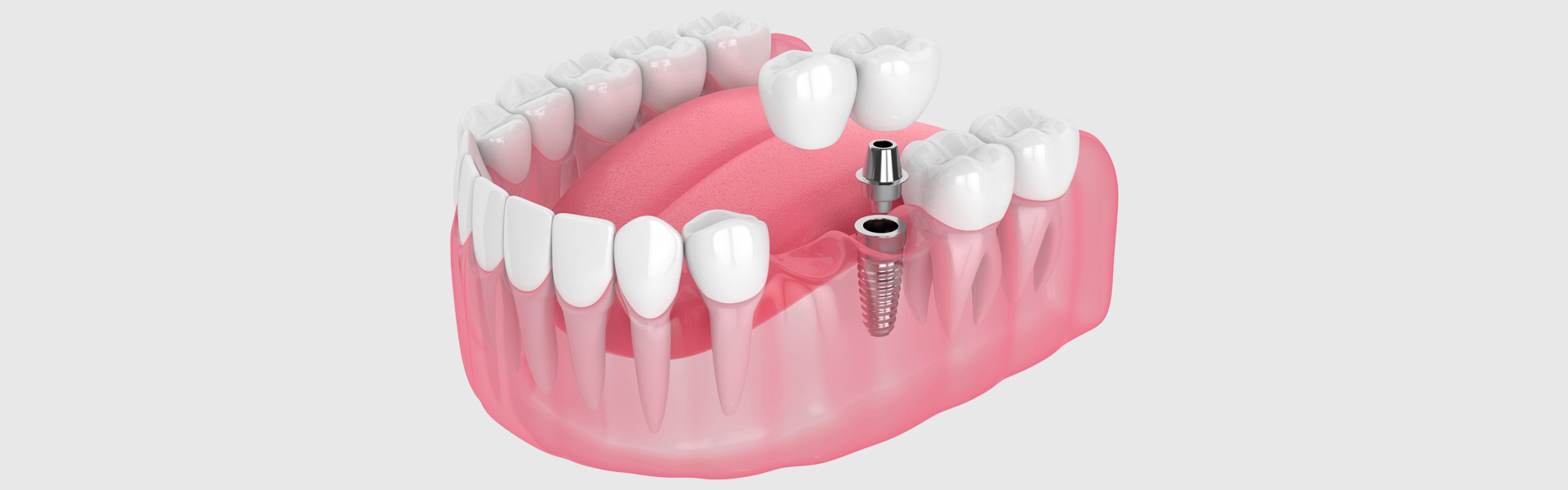 Dental Bridges vs. Dental Implants