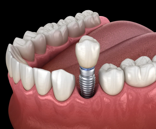 dental implants in Phoenix